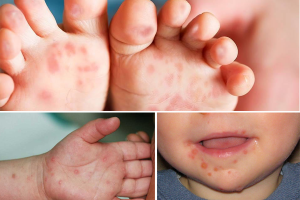 TRƯỜNG MN KỲ LONG XÂY DỰNG KẾ HOẠCH TUYÊN TRUYỀN PHÒNG CHỐNG BỆNH TAY CHÂN MIỆNG CHO TRẺ